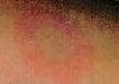 Bull's Eye Rash